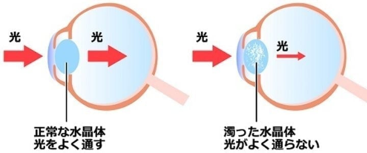 いわき市片桐眼科のメニュー、白内障診療のイラスト。