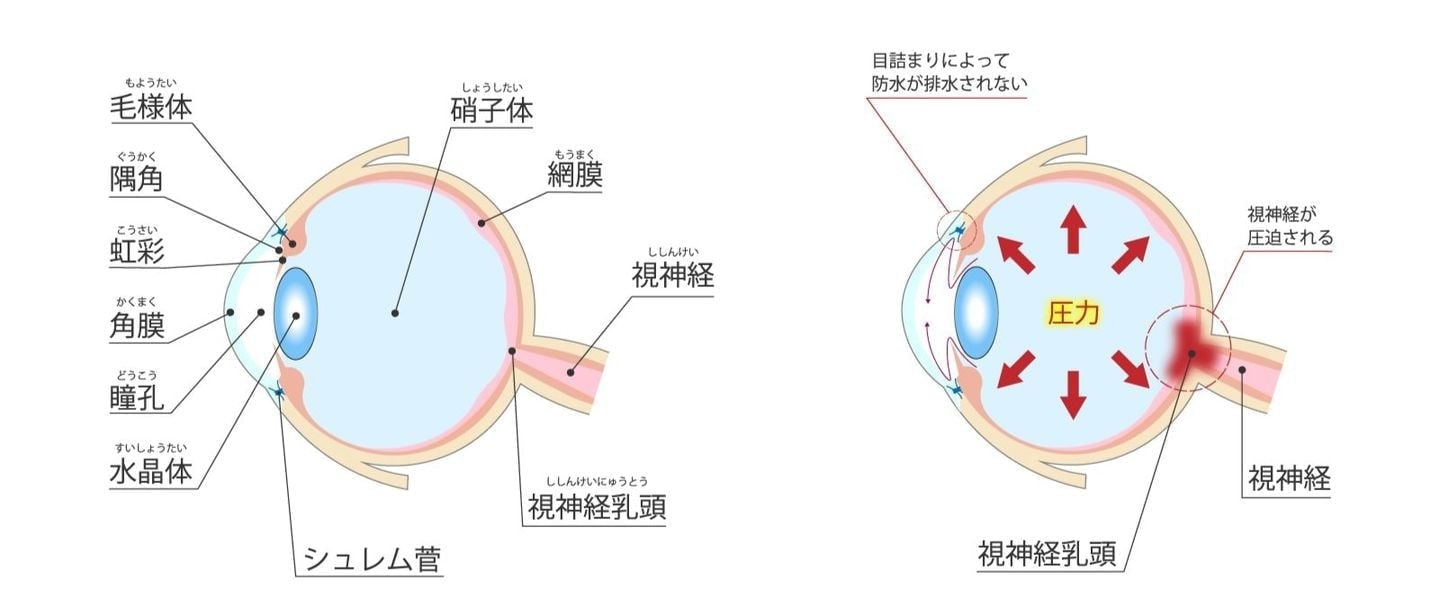 いわき市片桐眼科のメニュー、緑内障診療のイラスト。